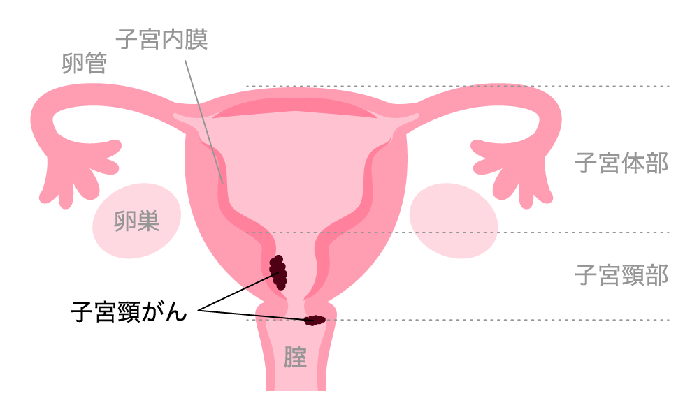 子宮頸がん