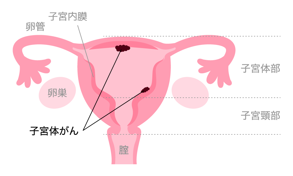 子宮体がん（子宮内膜がん）