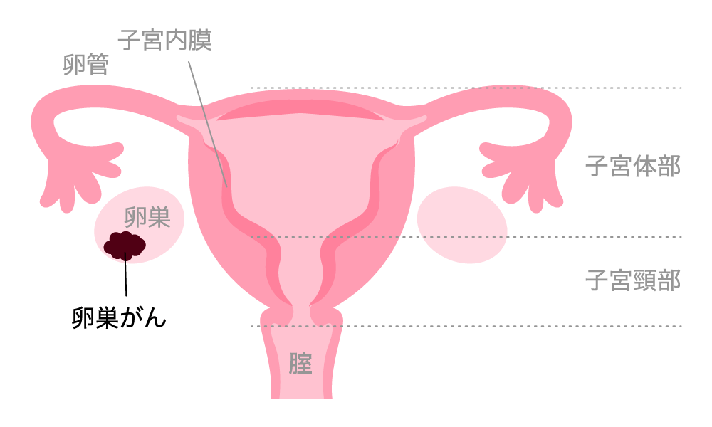 卵巣がん