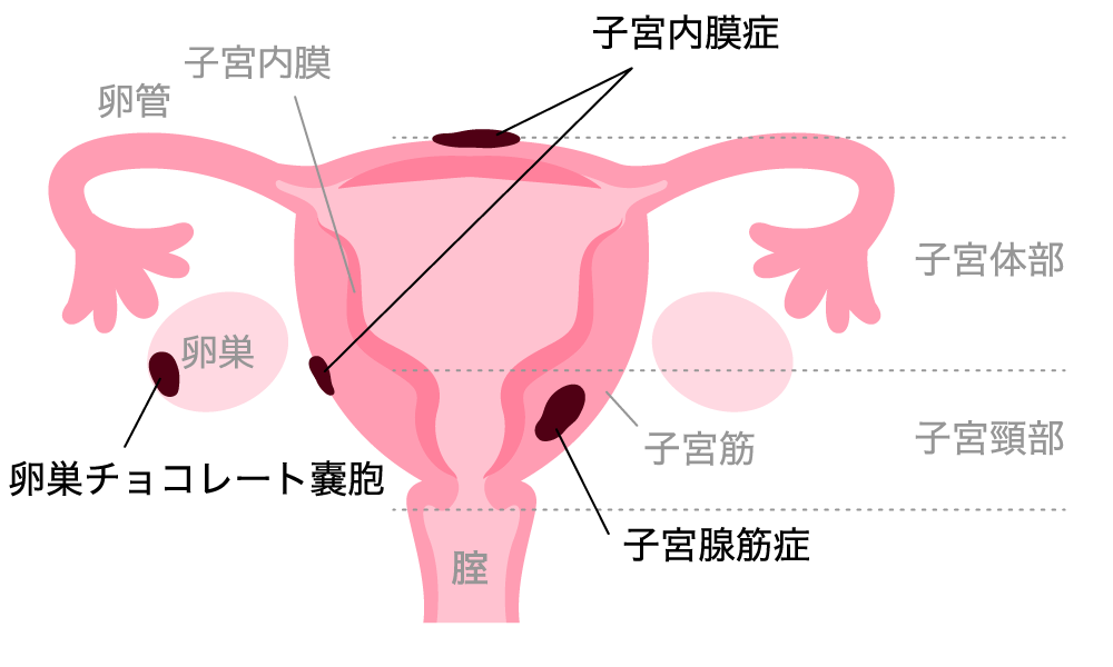 子宮内膜症、子宮腺筋症