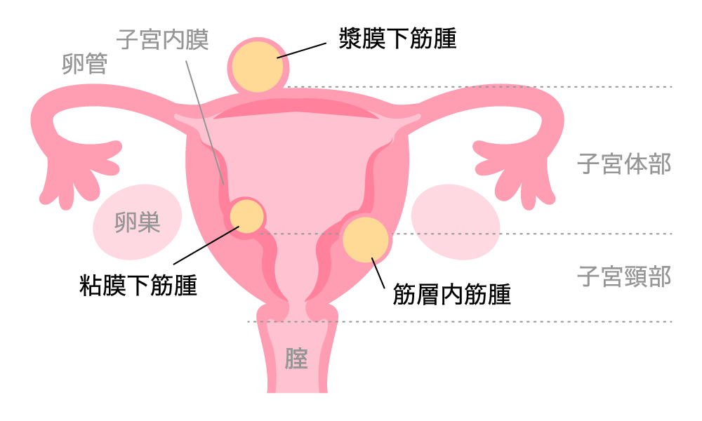 子宮筋腫